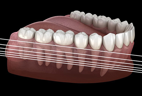 Illustration of bone shrinkage