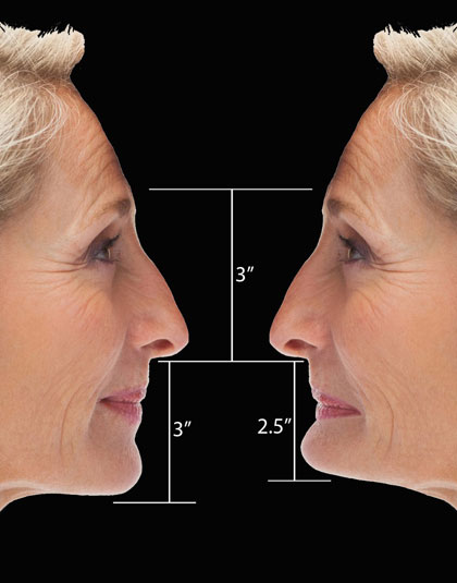 Side profile of woman wearing dentures vs not wearing dentures, where the jaw line is different