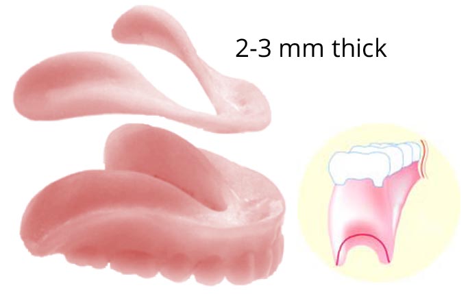 Illustration of 2-3mm thick gums